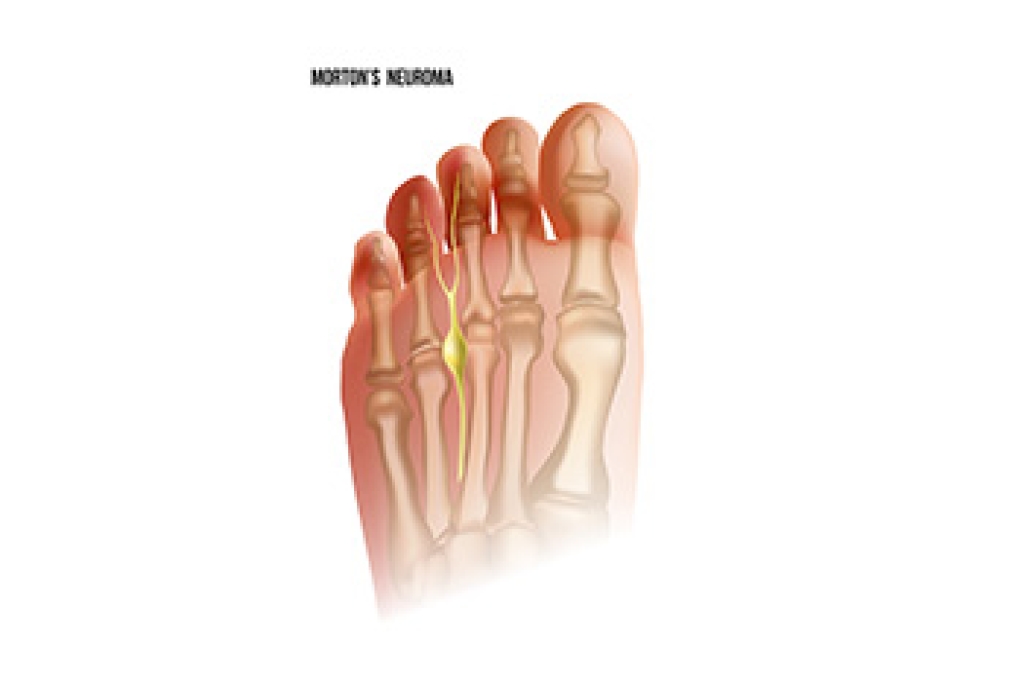 Morton’s Neuroma Symptoms and Risk Factors Explained