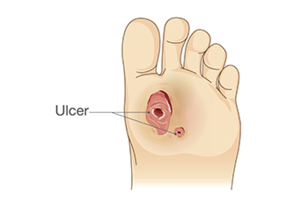 Types of Care for Diabetic Foot Ulcers