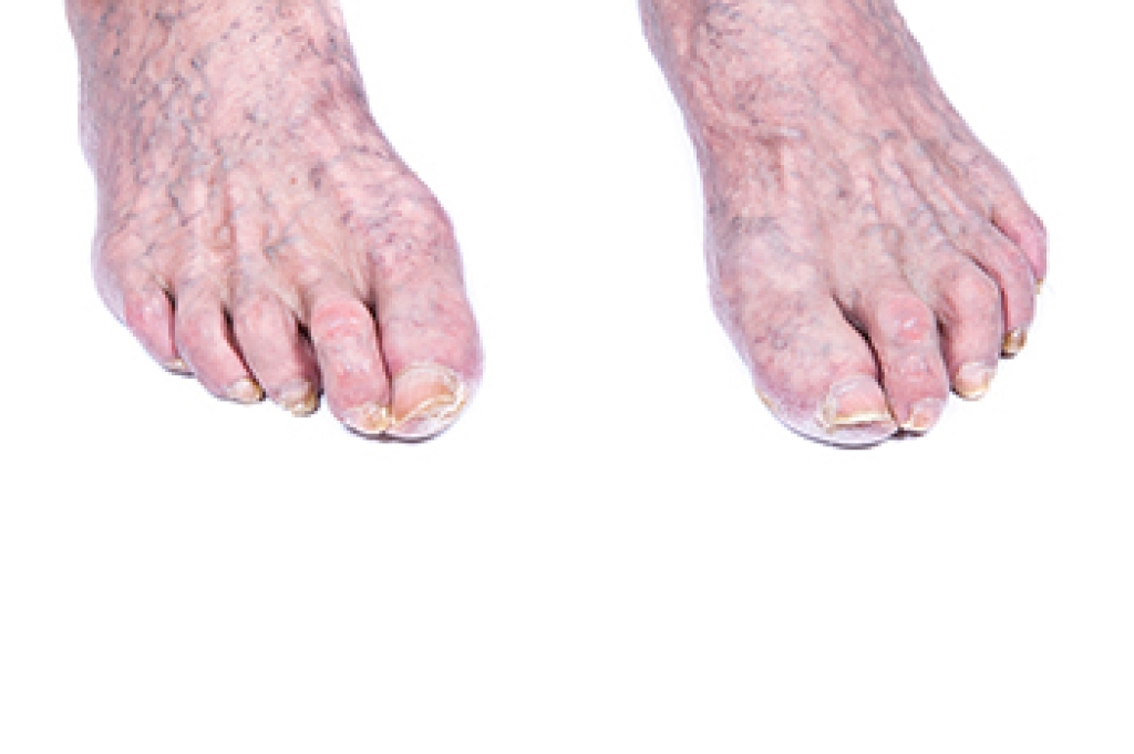 Common Toenail Problems in Older Adults