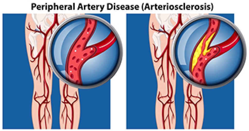 How Peripheral Artery Disease Affects Foot Health