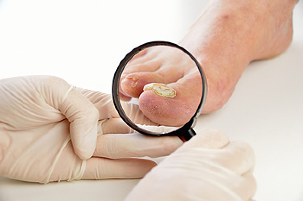 Podiatry Care for Thick Painful Toenails