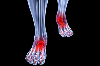 arthritic foot care in the Nevada County, CA: Grass Valley (Union Hill, Truckee, Peardale, Willow Valley, La Barr Meadows, Alta Sierra, Nevada City), as well as Placer County, CA: Roseville, Lincoln, Auburn, and Sutter County, CA: Yuba City, Live Oak areas