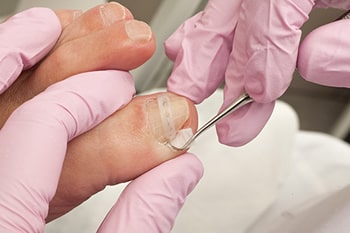 ingrown toenail treatment in the Nevada County, CA: Grass Valley (Union Hill, Truckee, Peardale, Willow Valley, La Barr Meadows, Alta Sierra, Nevada City), as well as Placer County, CA: Roseville, Lincoln, Auburn, and Sutter County, CA: Yuba City, Live Oak areas
