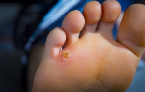 Removing Hard Skin on the Foot