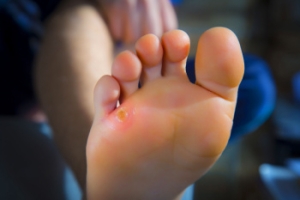 Types of Corns and Relief Methods
