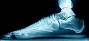 What Are Different Methods for Treating Flat Feet?