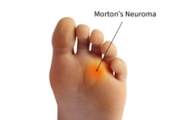 Recognizing the Signs of Morton’s Neuroma