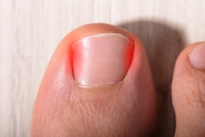 How Are Ingrown Toenails Treated?