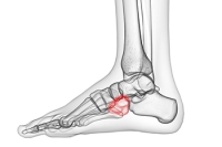 The Ankle, the Outside of the Foot, and Cuboid Syndrome