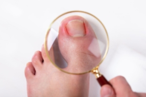 Ingrown Toenail Management