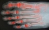 How Rheumatoid Arthritis Affects the Feet, Toes, and Ankles