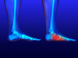 An Association Between Obesity and Flat Feet