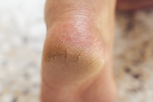 The Connection Between Cracked Heels and Diabetes
