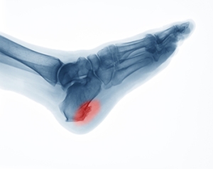 Preventing Heel Spur Pain