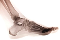 Symptoms and Causes of Tarsal Tunnel Syndrome