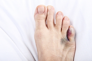 Pain in the Pinky Toe