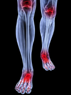 Rheumatoid Arthritis and the Feet