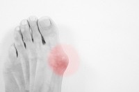 Various Reasons Why Bunions May Develop