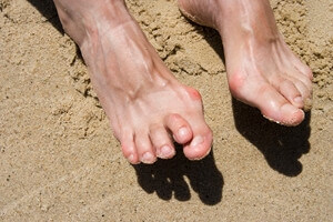 Hammertoe Is a Common Deformity